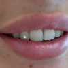 TOOTH GEM 1 STEIN