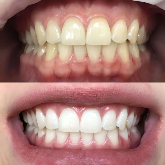 KOSMETISCHES BLEACHING